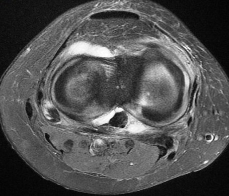 Figure 5 for case Meniscus tears ( RID2762 )
